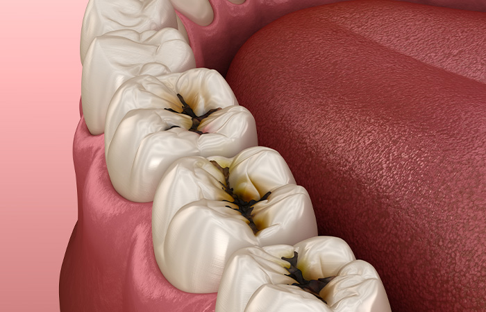 歯の寿命を守るために、早期発見・早期治療を