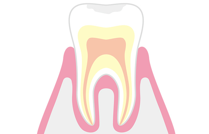 むし歯の進行と治療
