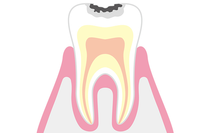 エナメル質にできたむし歯