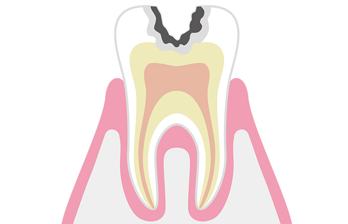 象牙質まで進んだむし歯