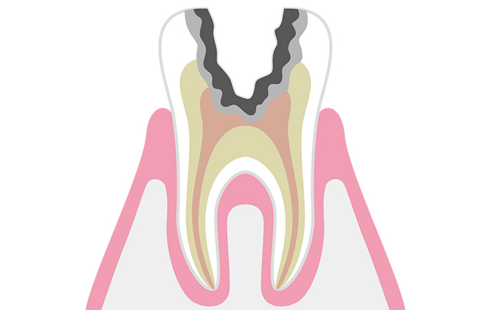 神経まで進んだむし歯