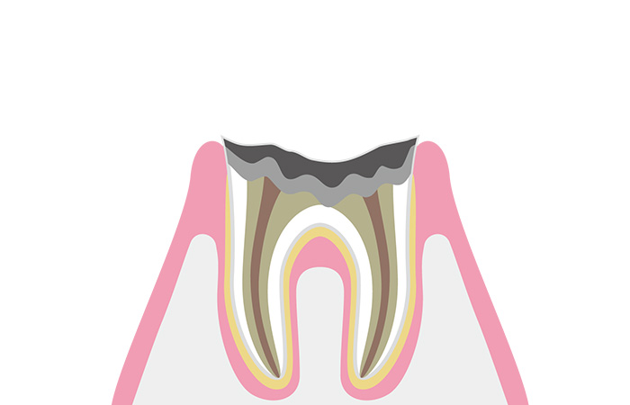 歯根のみが残ったむし歯