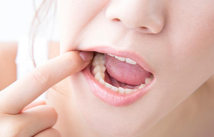 大人のむし歯の特徴